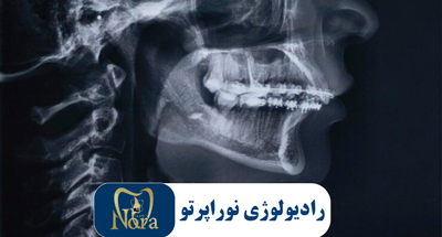 رادیوگرافی خارج دهانی