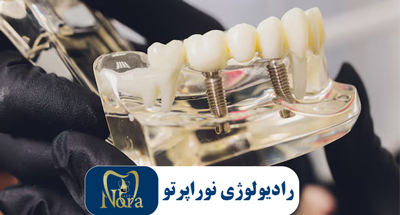 مراحل کاشت ایمپلنت دندان از ابتدا تا پایان