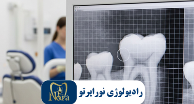 رادیوگرافی پری اپیکال | تشخیص دقیق ریشه و استخوان دندان